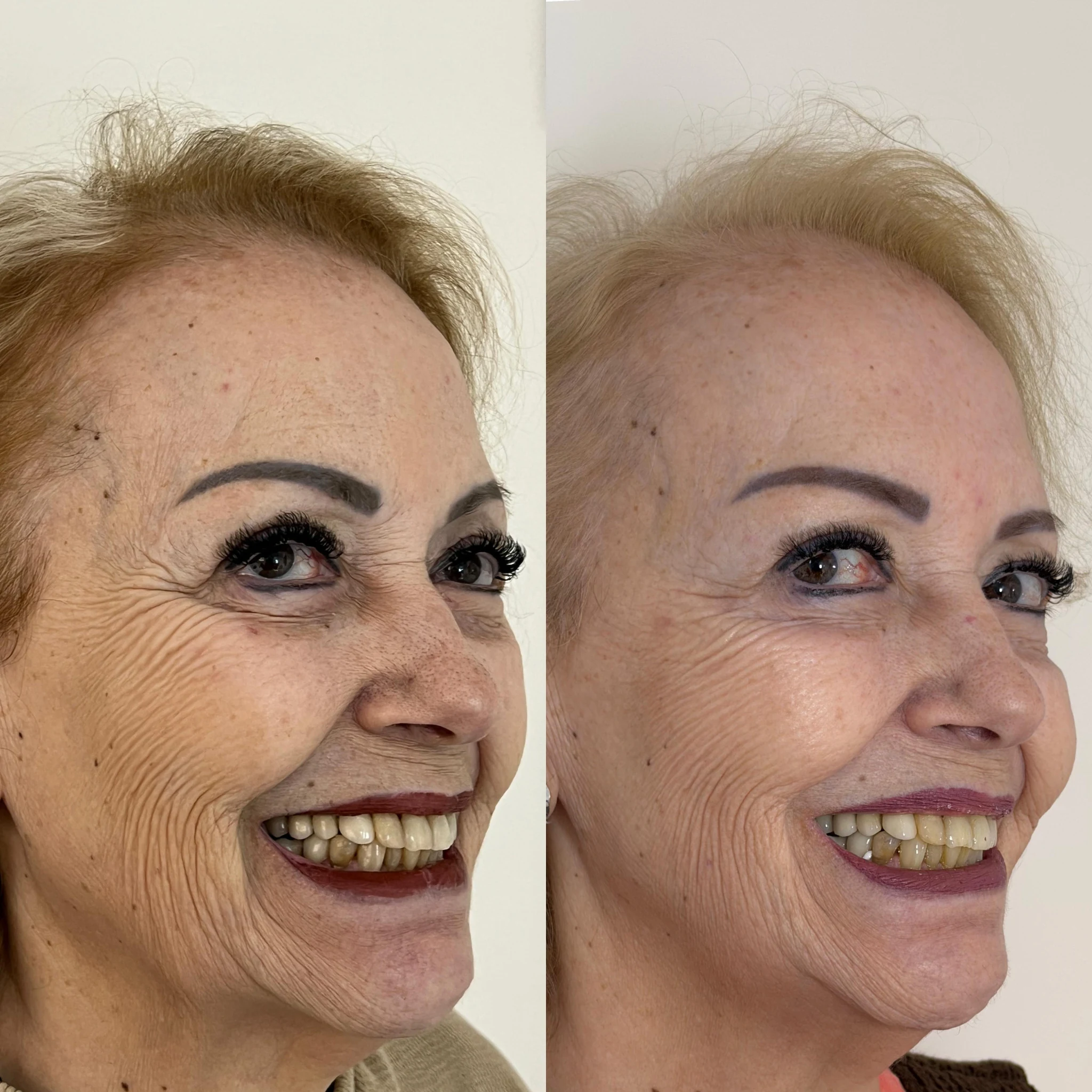 Antes e depois de bioestimulador de colágeno — perspectiva