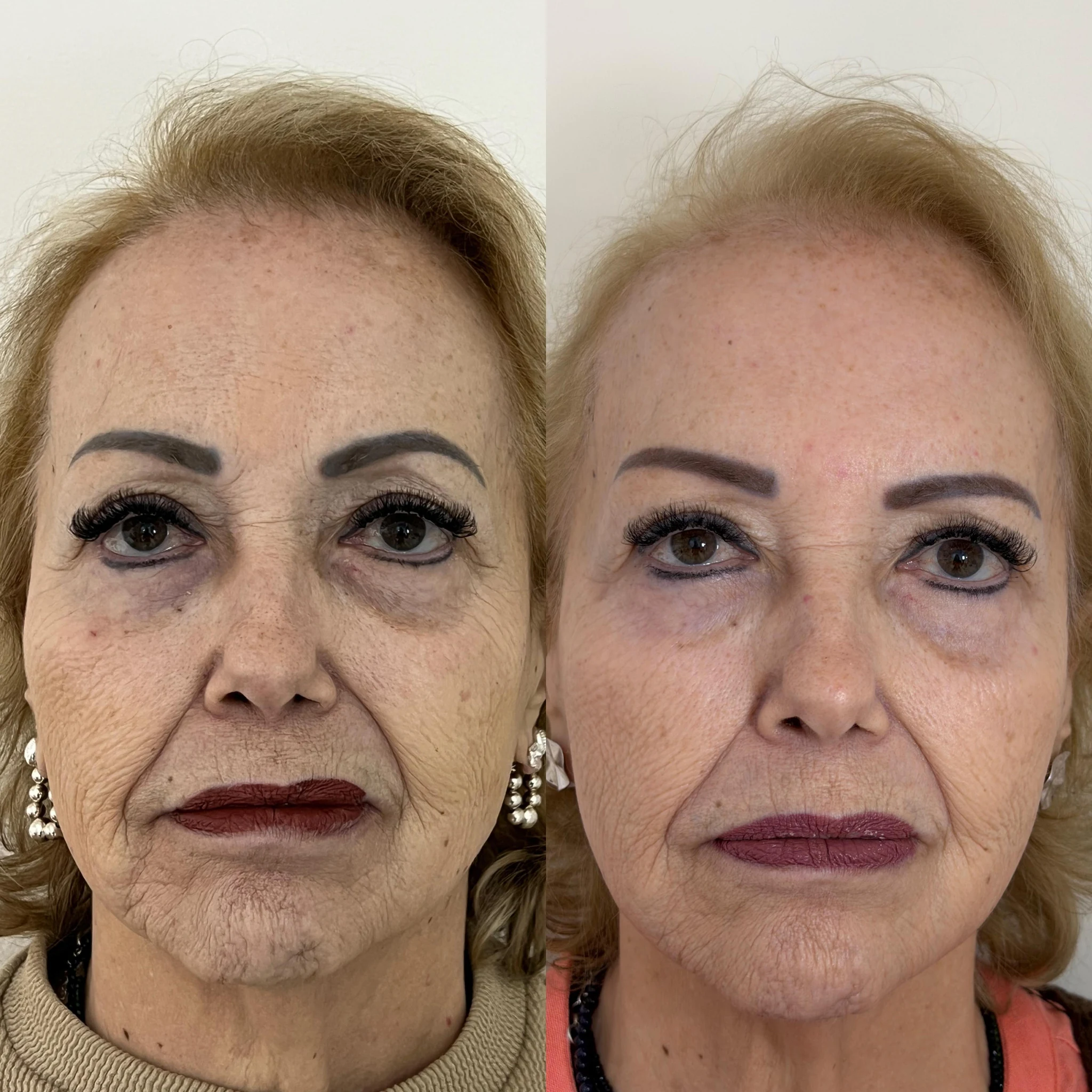Antes e depois de bioestimulador de colágeno — frontal
