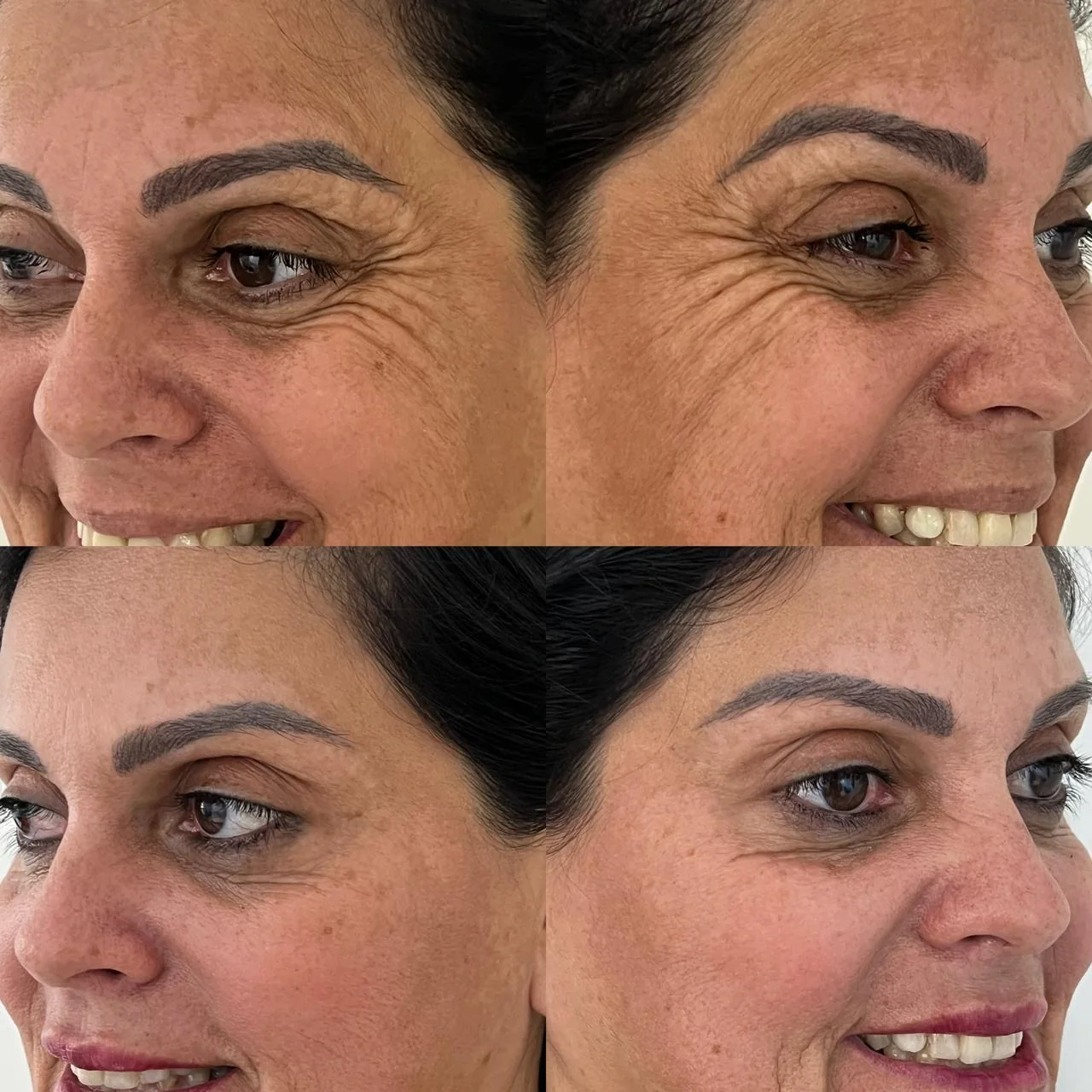 Resultado de Botox em pés de galinha