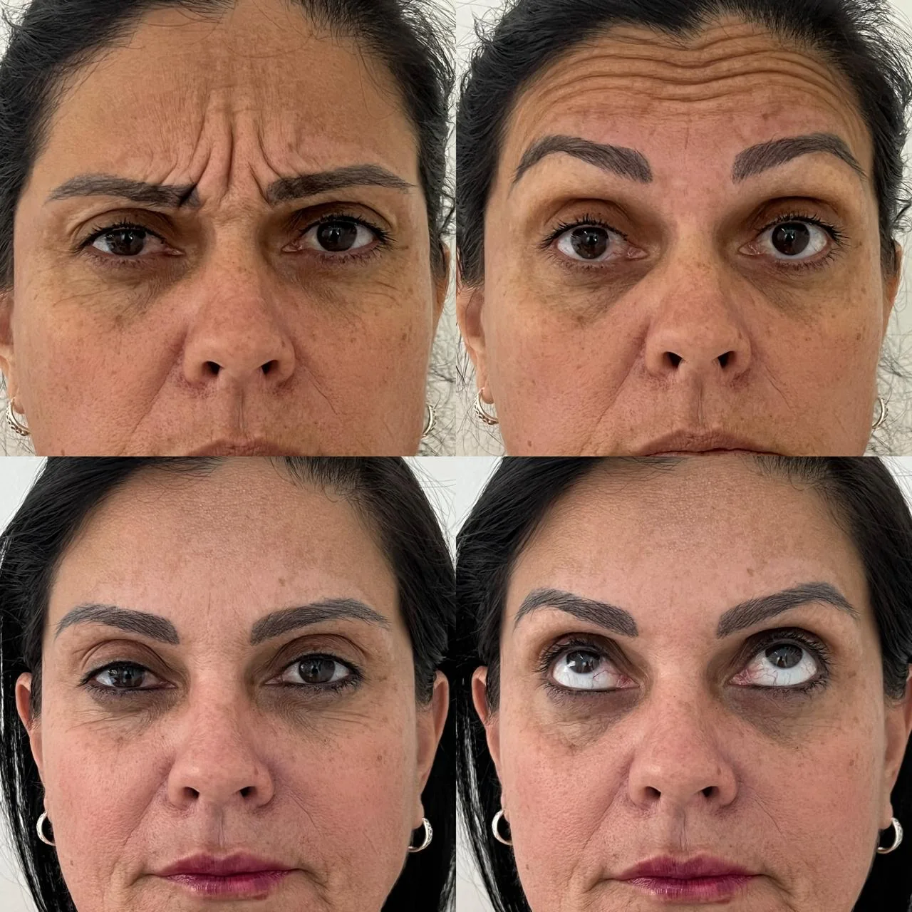 Antes e depois de Botox no terço superior da face