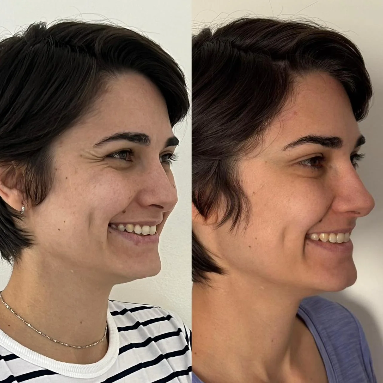 Botox — resultado individual