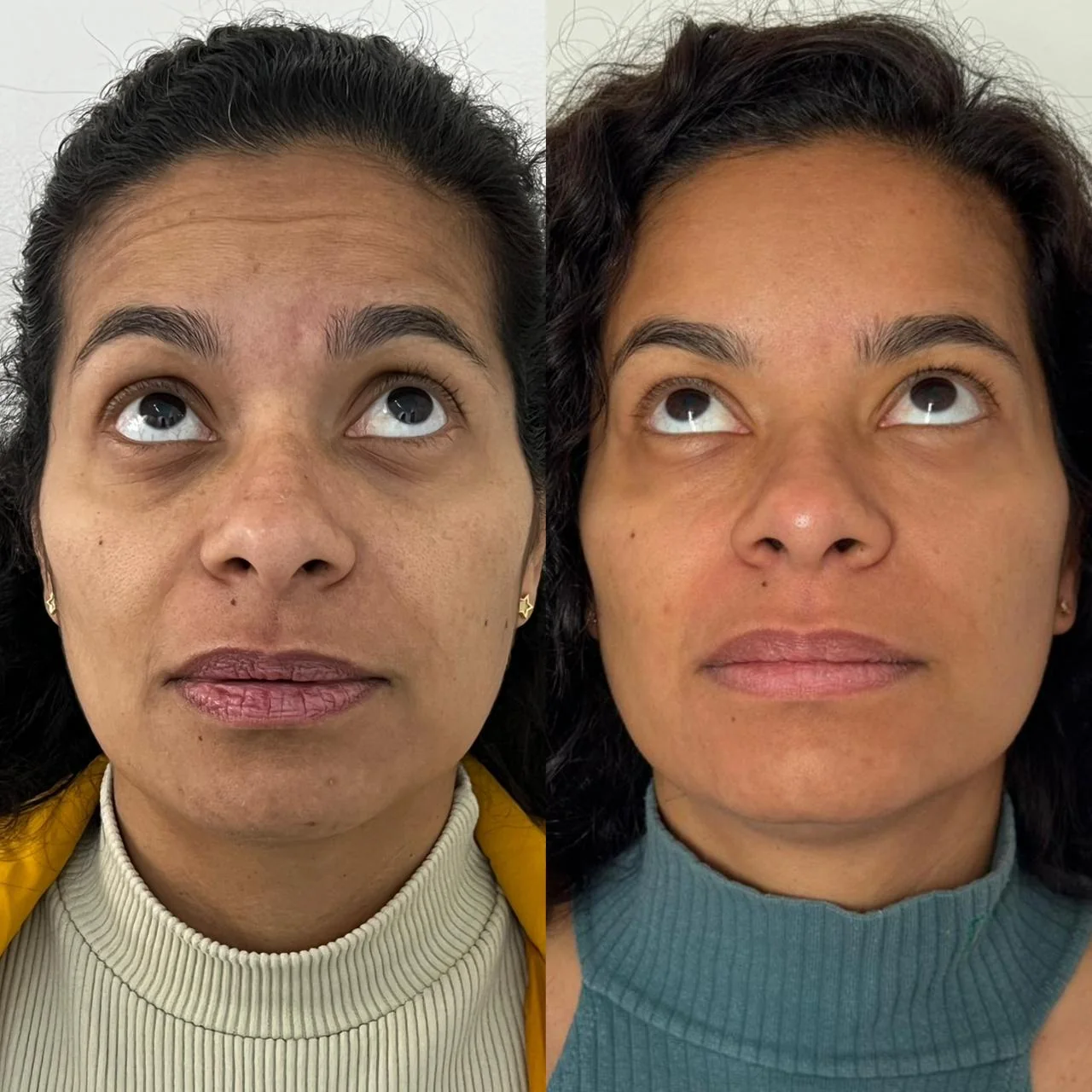 Botox — suavização de linhas