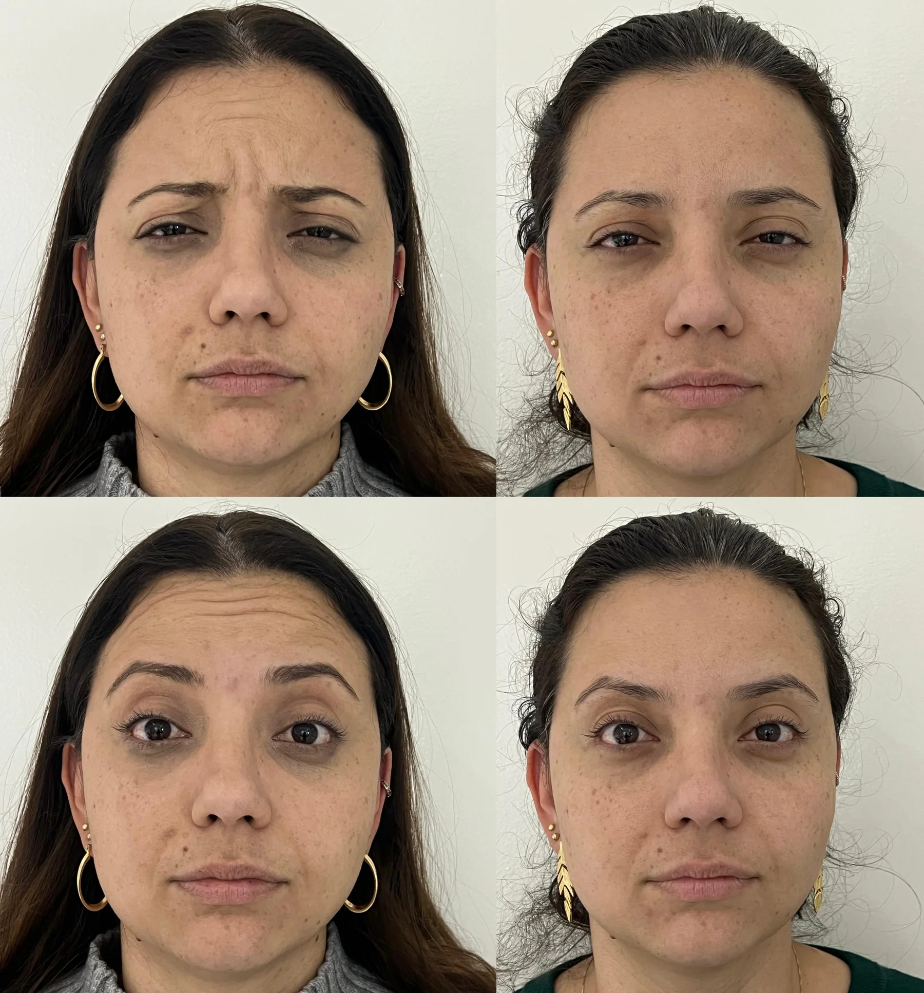 Botox — testa e glabela