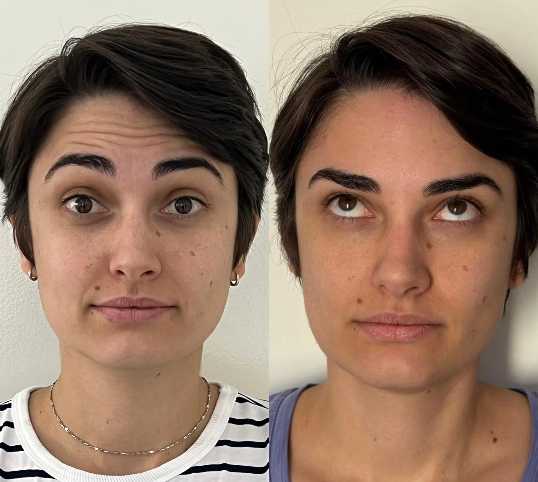 Botox — expressão e testa