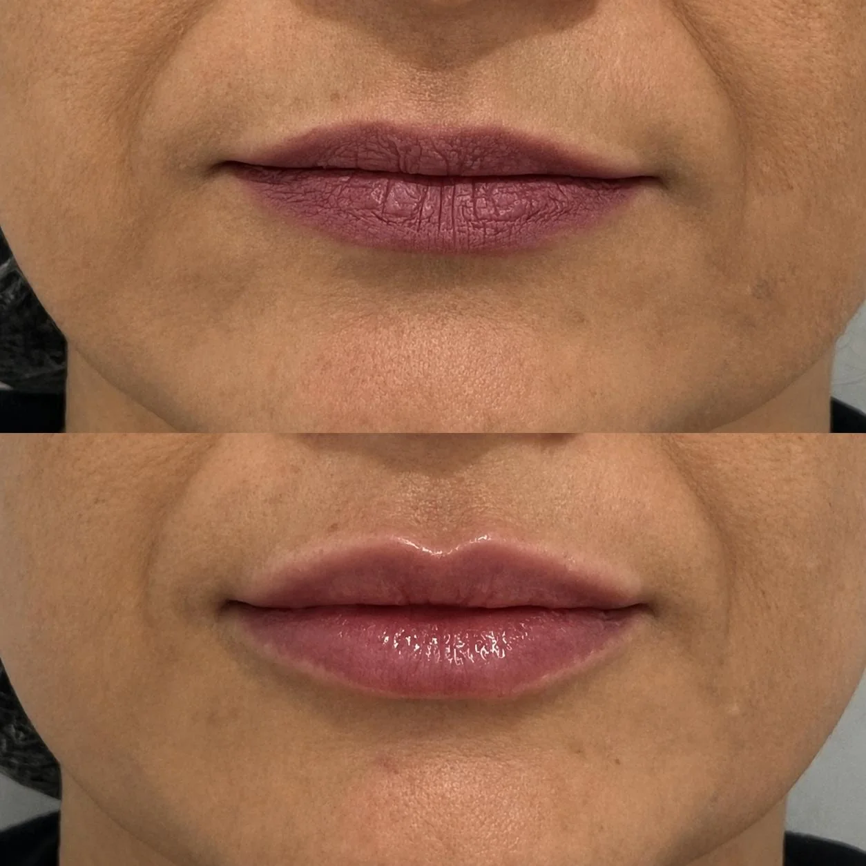 Antes e depois de preenchimento labial