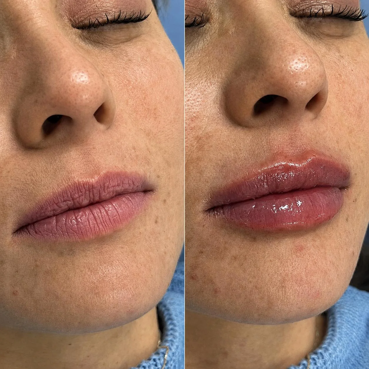 Resultado de preenchimento labial em perspectiva