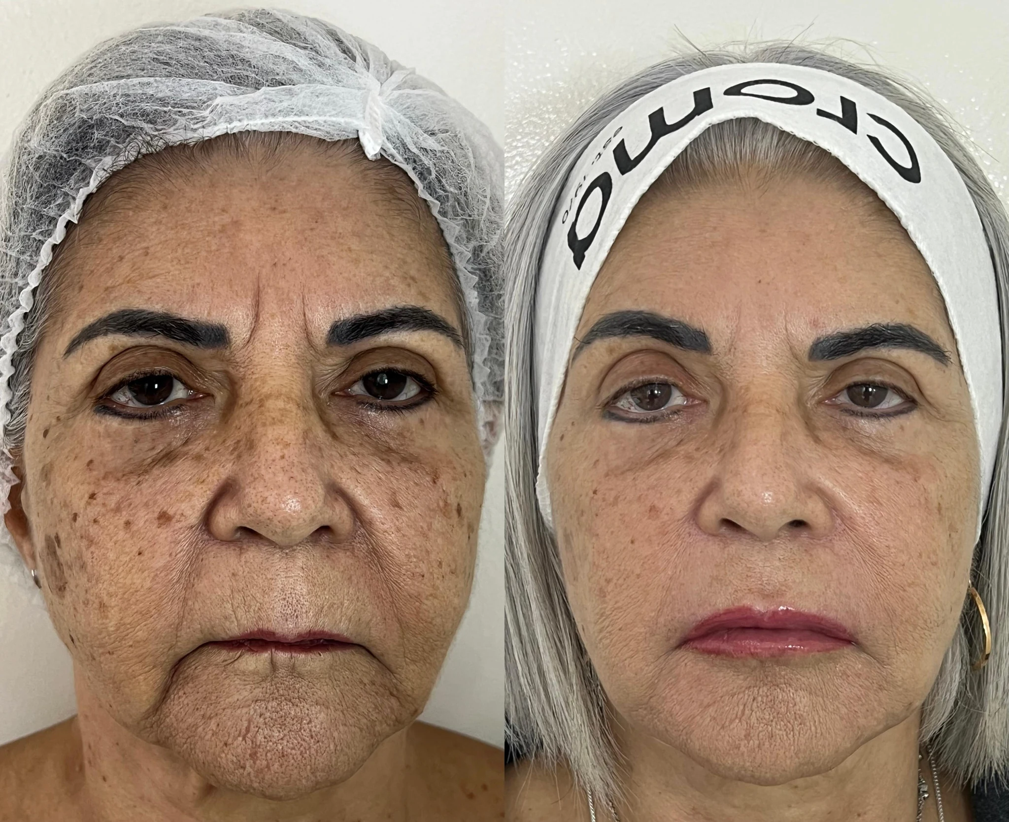 Antes e depois de preenchimento facial — frontal