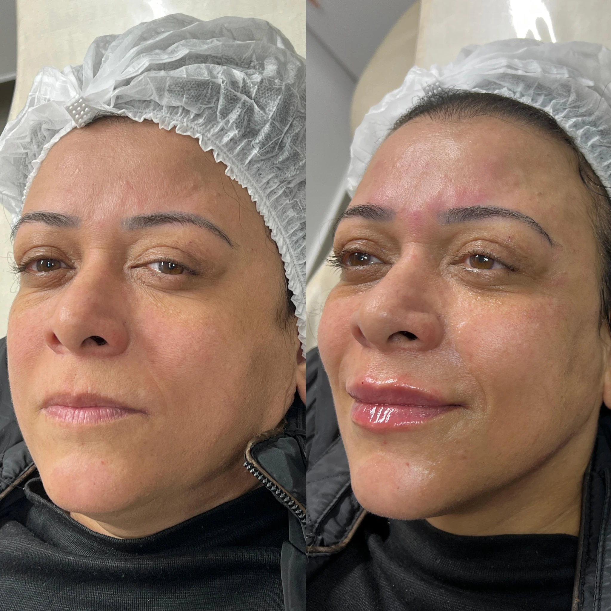 Antes e depois de preenchimento facial — perspectiva