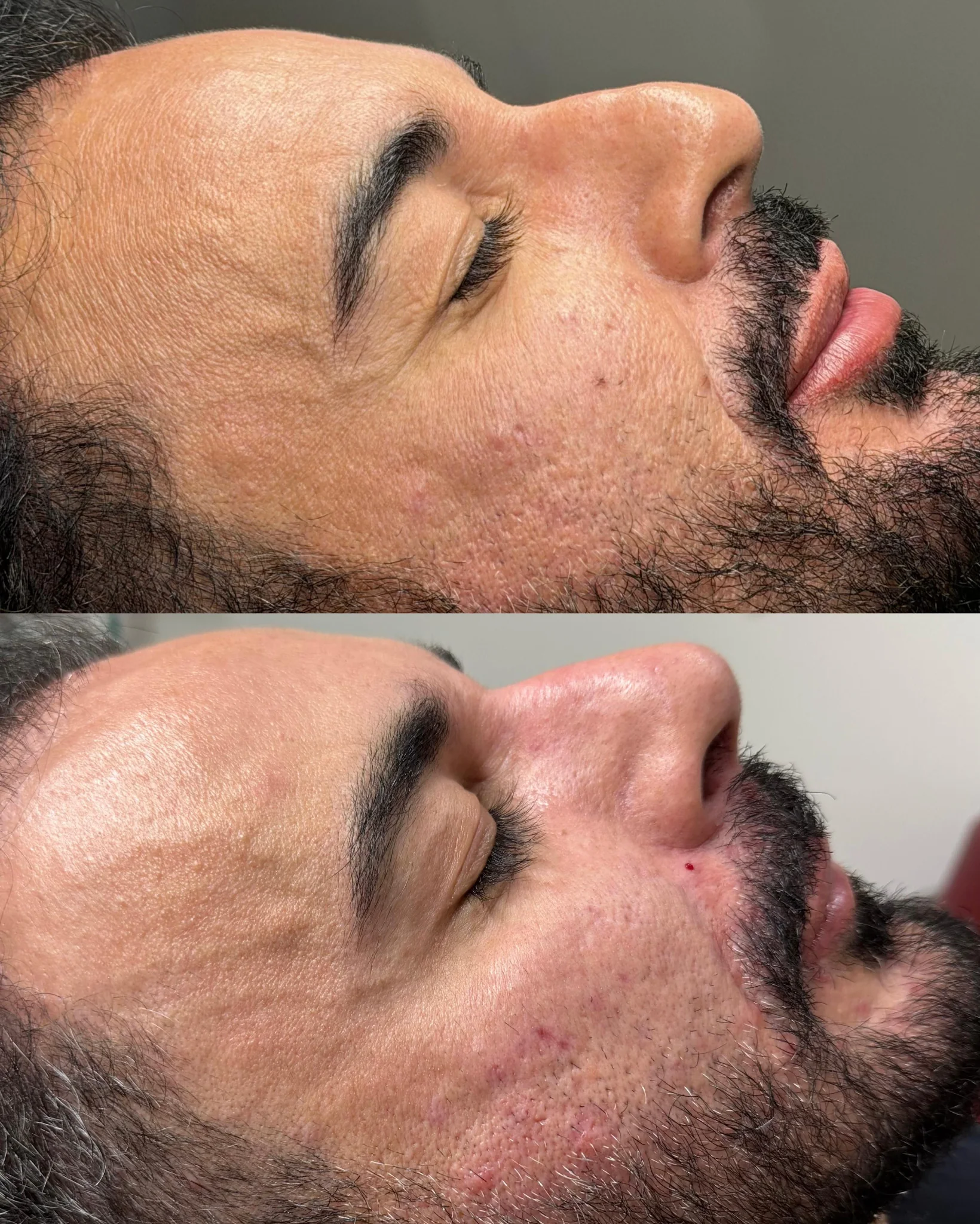 Rinomodelação — perfil masculino