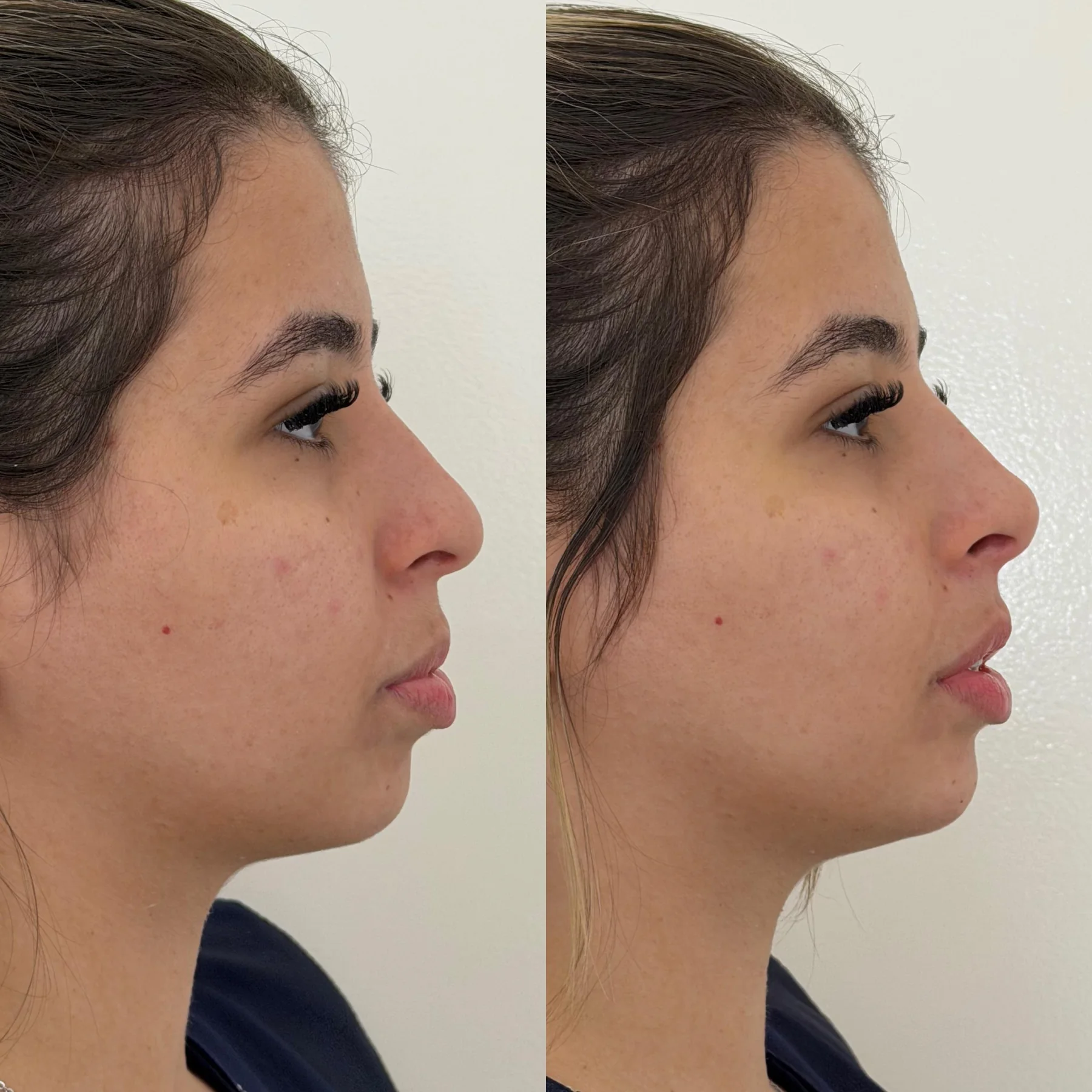 Antes e depois de rinomodelação